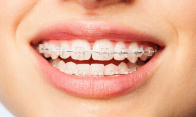 best dental braces in Gujarat