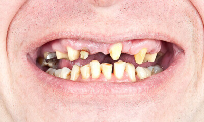 Best Dental implant in Surat