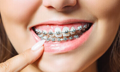 orthodontic braces in Gujarat