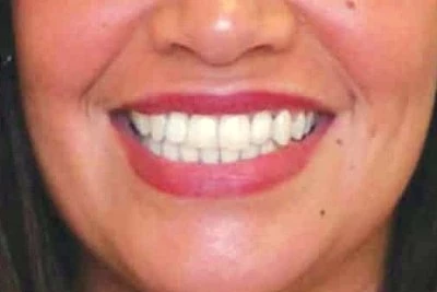 wisdom teeth removal in Surat