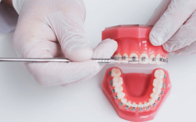 dental braces in Surat