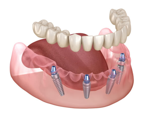 teeth replacement implant treatment in Surat