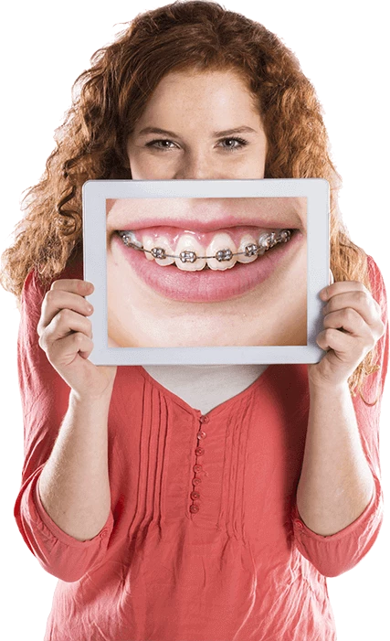 Best clear Aligners in Surat