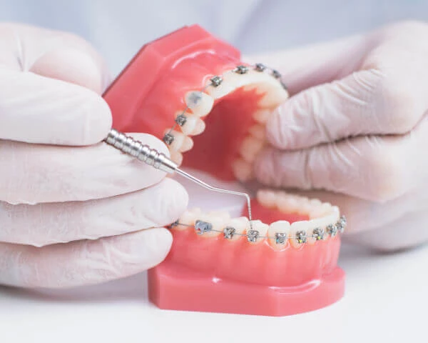 Best Orthodontic Braces Doctor in Surat