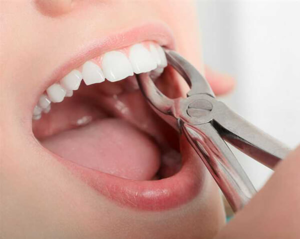 get best wisdom teeth extraction treatment in Surat