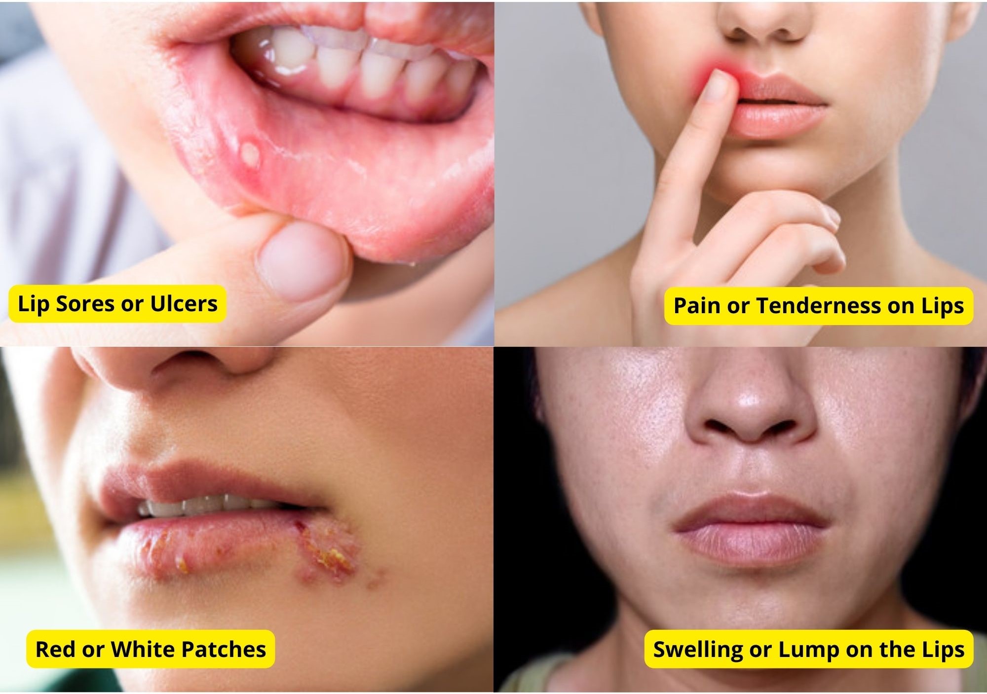 lip-cancer-5-symptoms-causes-treatment