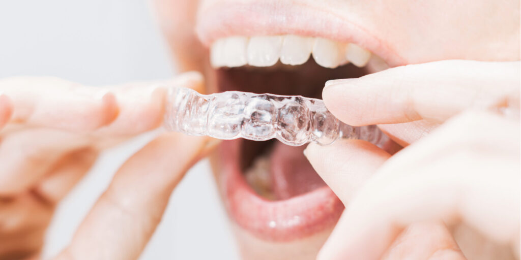 Best Clear Aligners or Invisible Aligners in Gujarat,