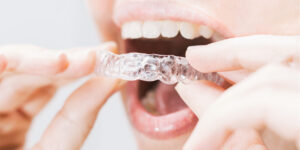 Best Clear Aligners or Invisible Aligners in Gujarat,