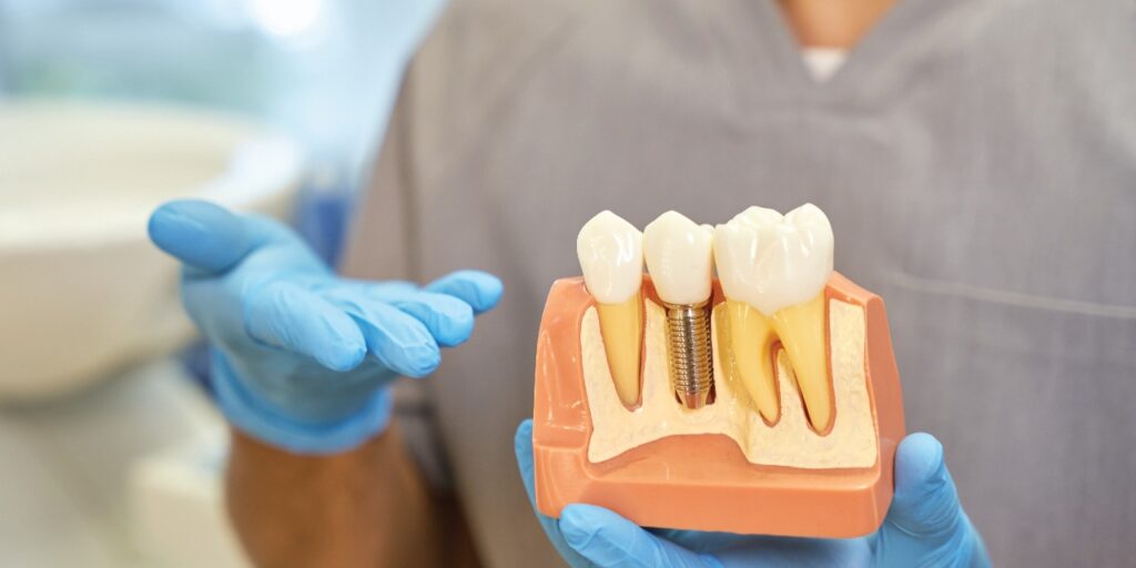 Dental Implants are stop solution