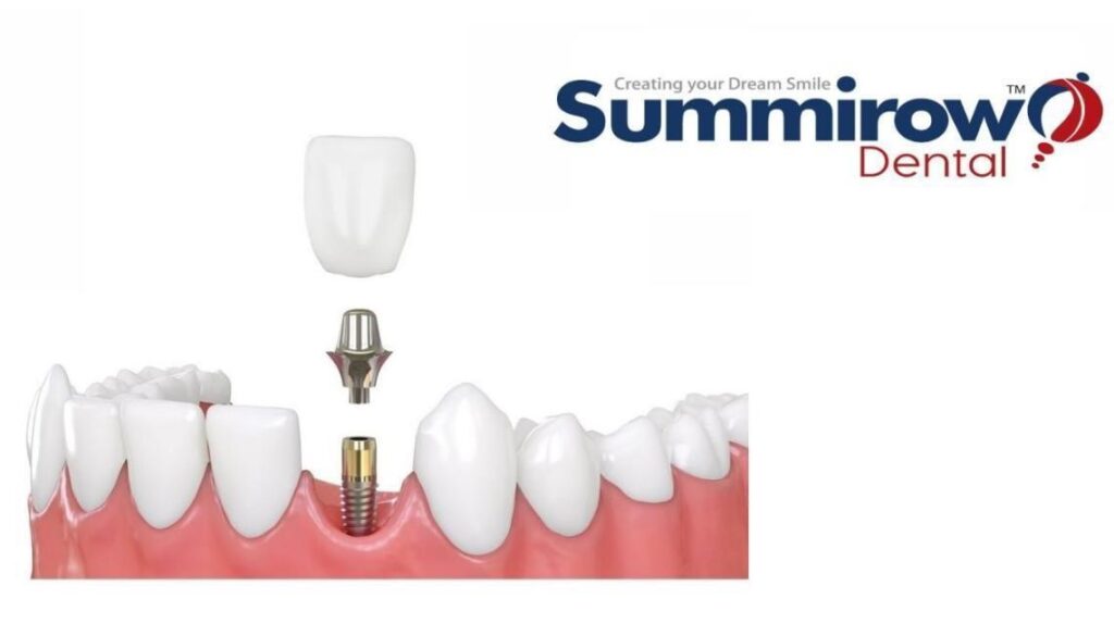 Root Canal Treatment, Dental Implants,