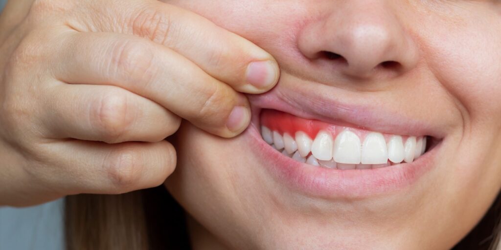 Gum Diseases