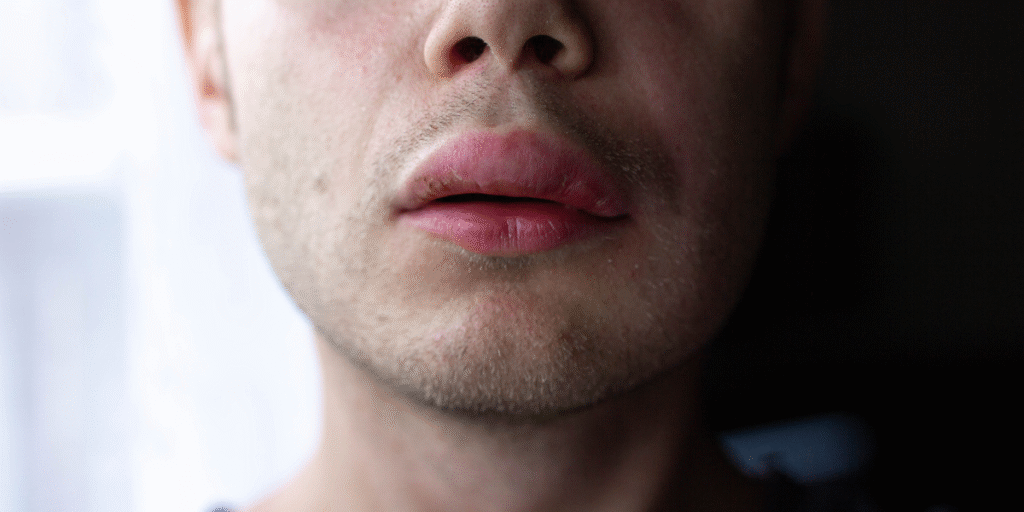 Lip Cancer