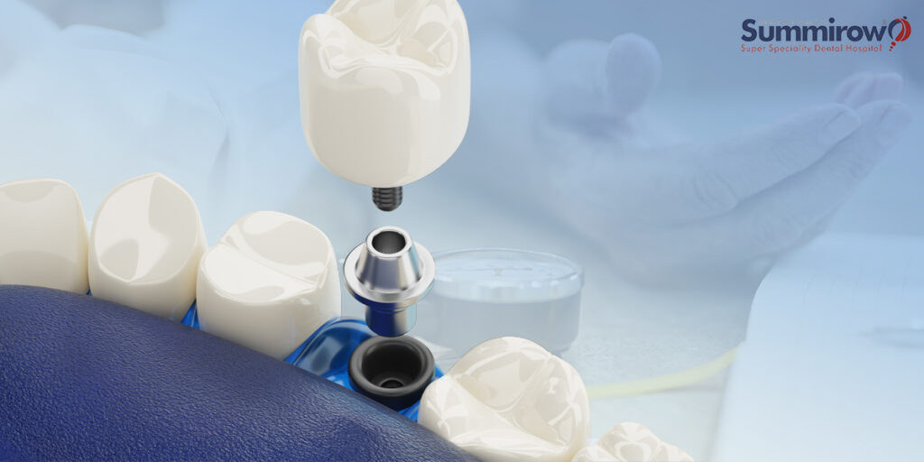 How Dental Implants Benefit Seniors with Diabetes and High Blood Pressure