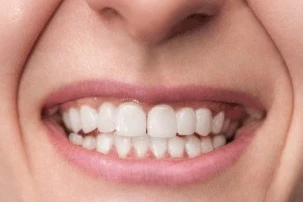 Best Teeth Braces in Surat