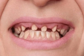 Best Clear Aligners in Gujarat