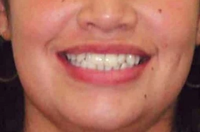 clear aligners in Gujarat