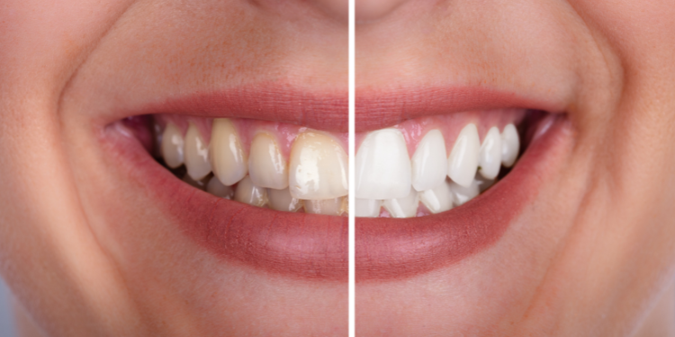 Get festival-ready with a Pre-Diwali dental makeover. Enjoy stain-free teeth, healthy gums, and a confident smile while indulging in festive sweets.