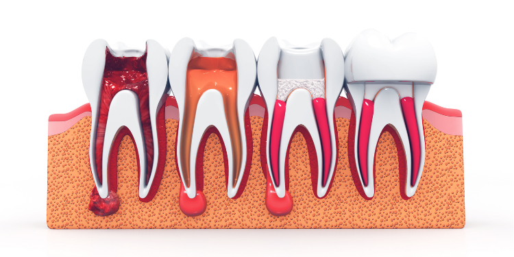 Delay Root Canal treatment at Summirow Dental to save tooth, prevent infection, and protect smile