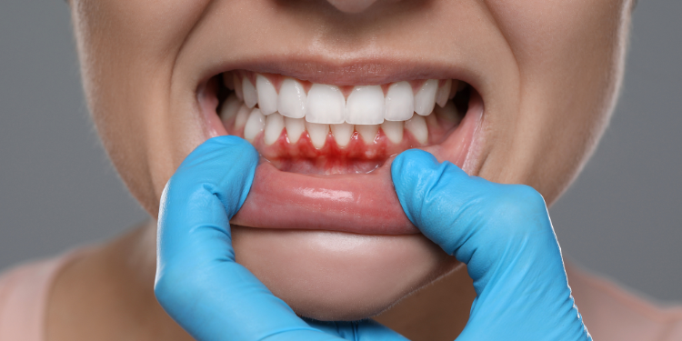 Dentist performing deep cleaning and gum therapy to prevent plaque and gum issues during monsoon season