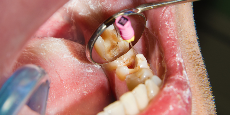 Dentist performing root canal treatment with dental instruments during Root Canal Awareness Drive