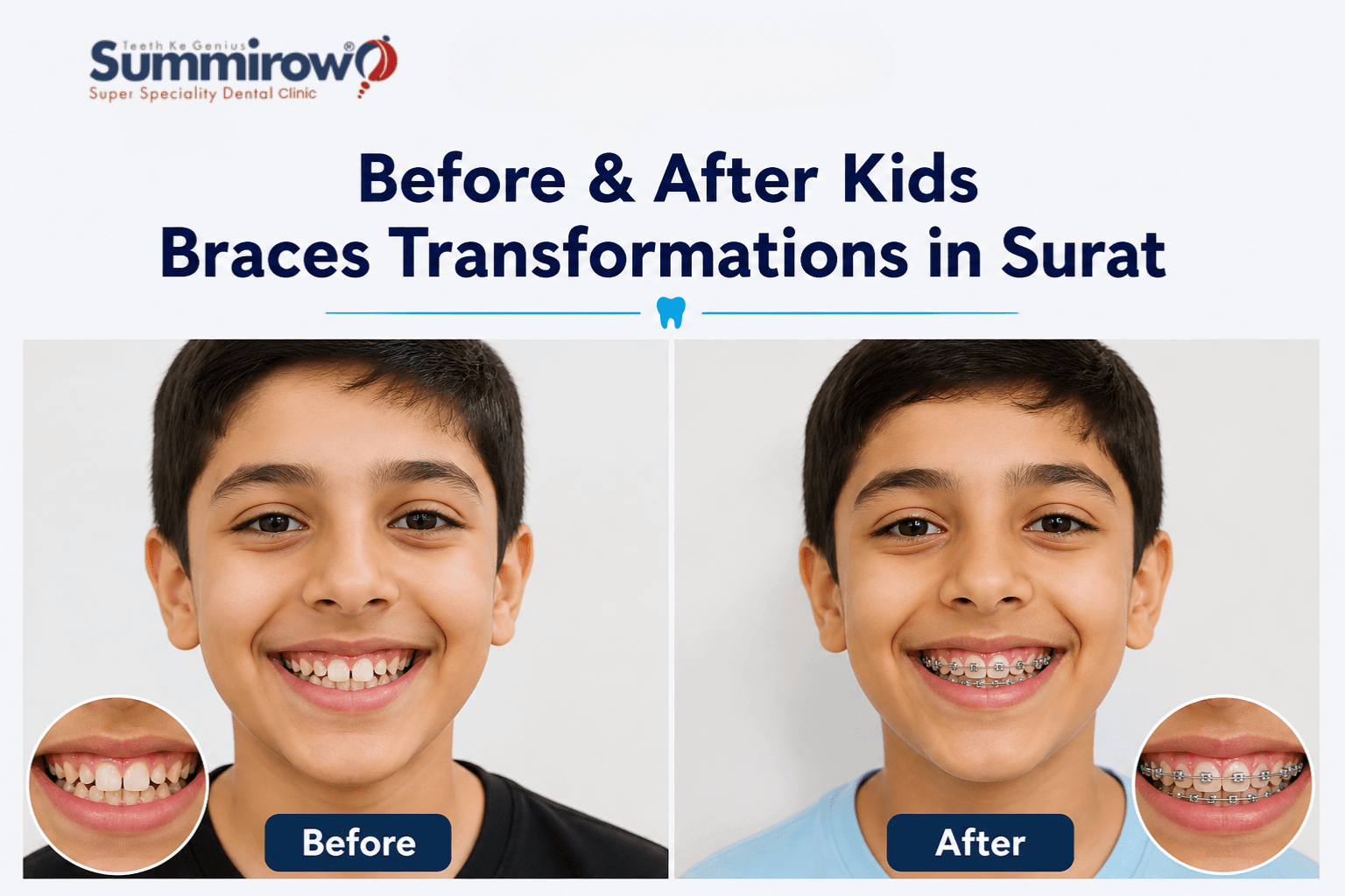 Before & After Kids Braces Transformations in Surat