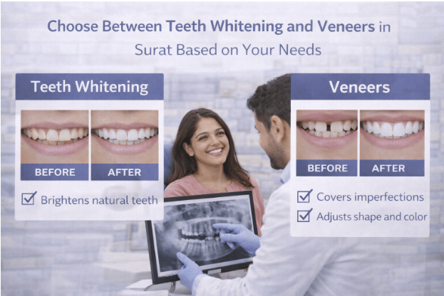 Teeth Whitening vs Veneers – Which Works Best in Surat?