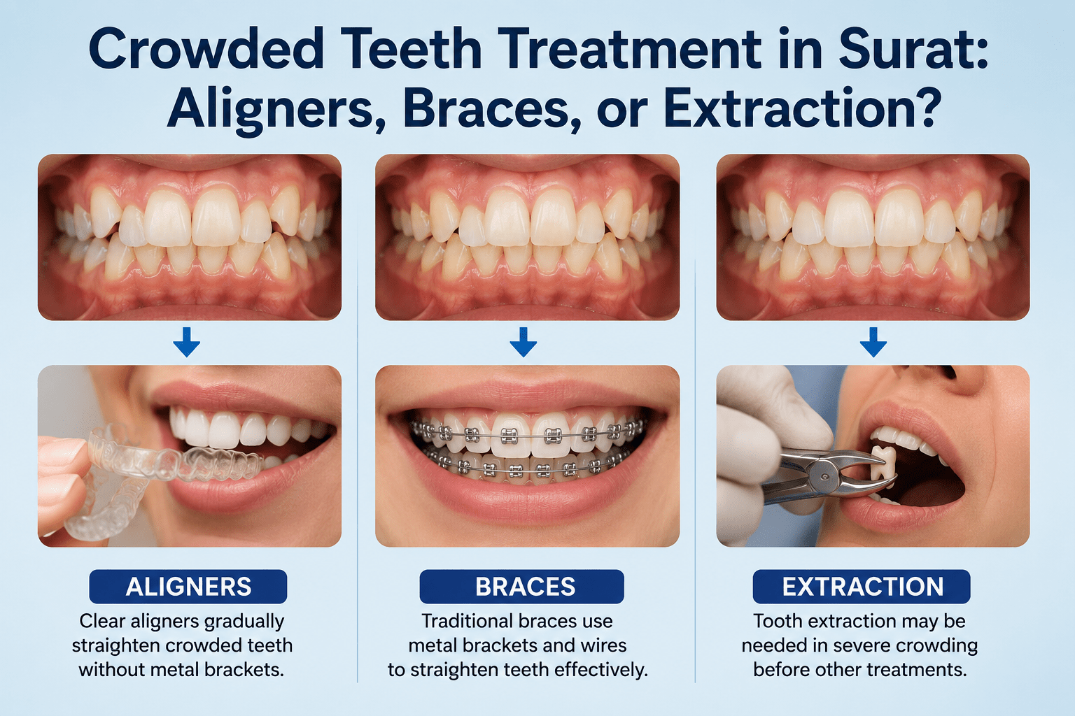 Crowded Teeth Treatment in Surat: Aligners, Braces, or Extraction?