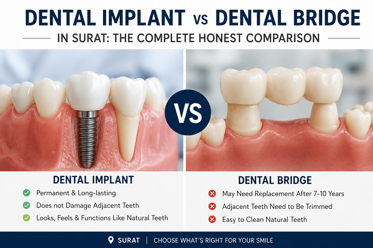 Dental Implant vs Dental Bridge in Surat: The Complete Honest Comparison