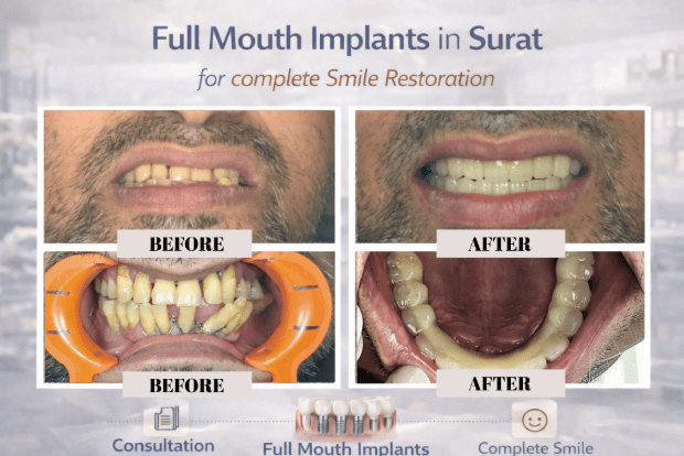 Full Mouth Implants in Surat: Transform Your Smile Safely