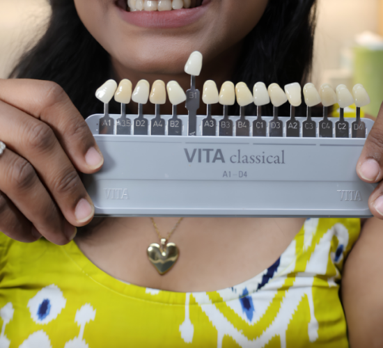 Dental Veneers