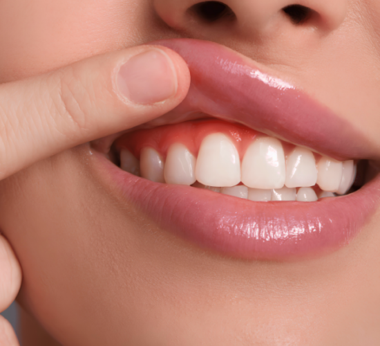 Gum Recontouring – Gummy Smile Correction
