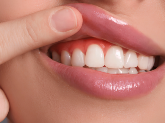 Gum Recontouring – Gummy Smile Correction