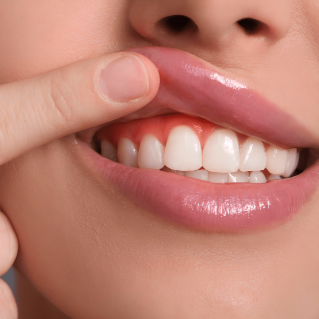Gum Recontouring – Gummy Smile Correction
