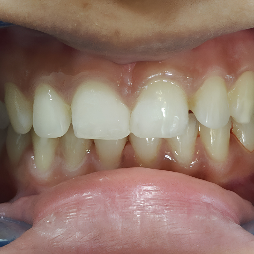 Before