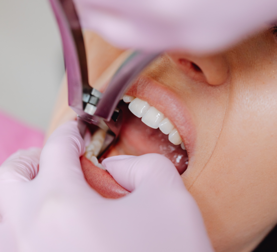 Wisdom Tooth Removal