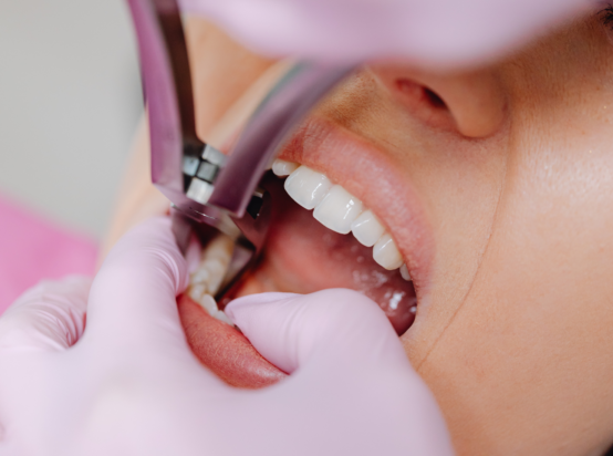 Wisdom Tooth Removal