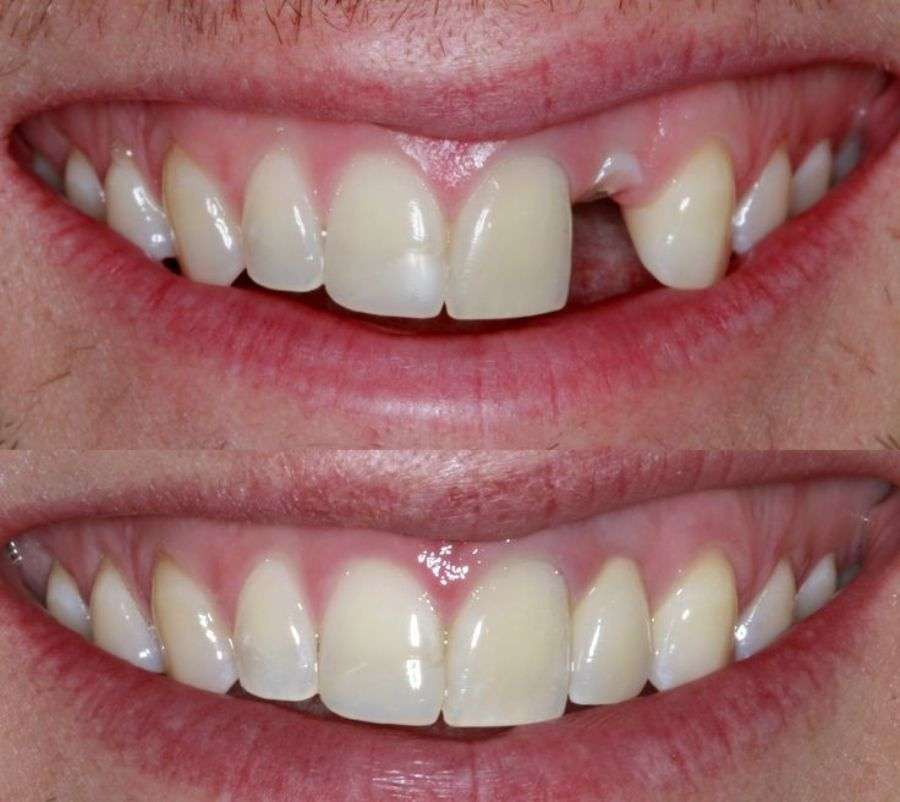 Before dental implant treatment — missing teeth, Summirow Dental Surat