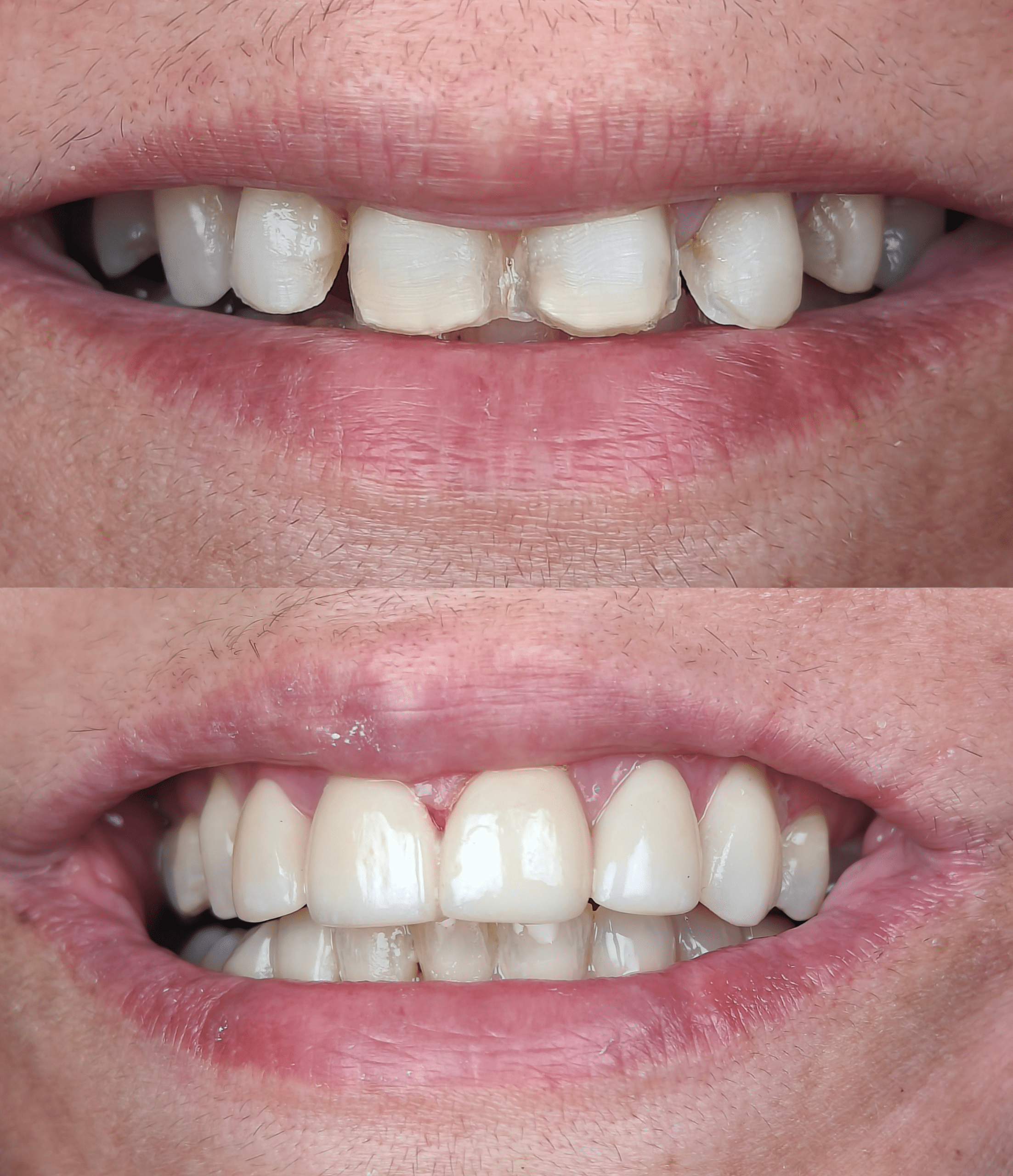 Front teeth gap closed with smile makeover — before and after