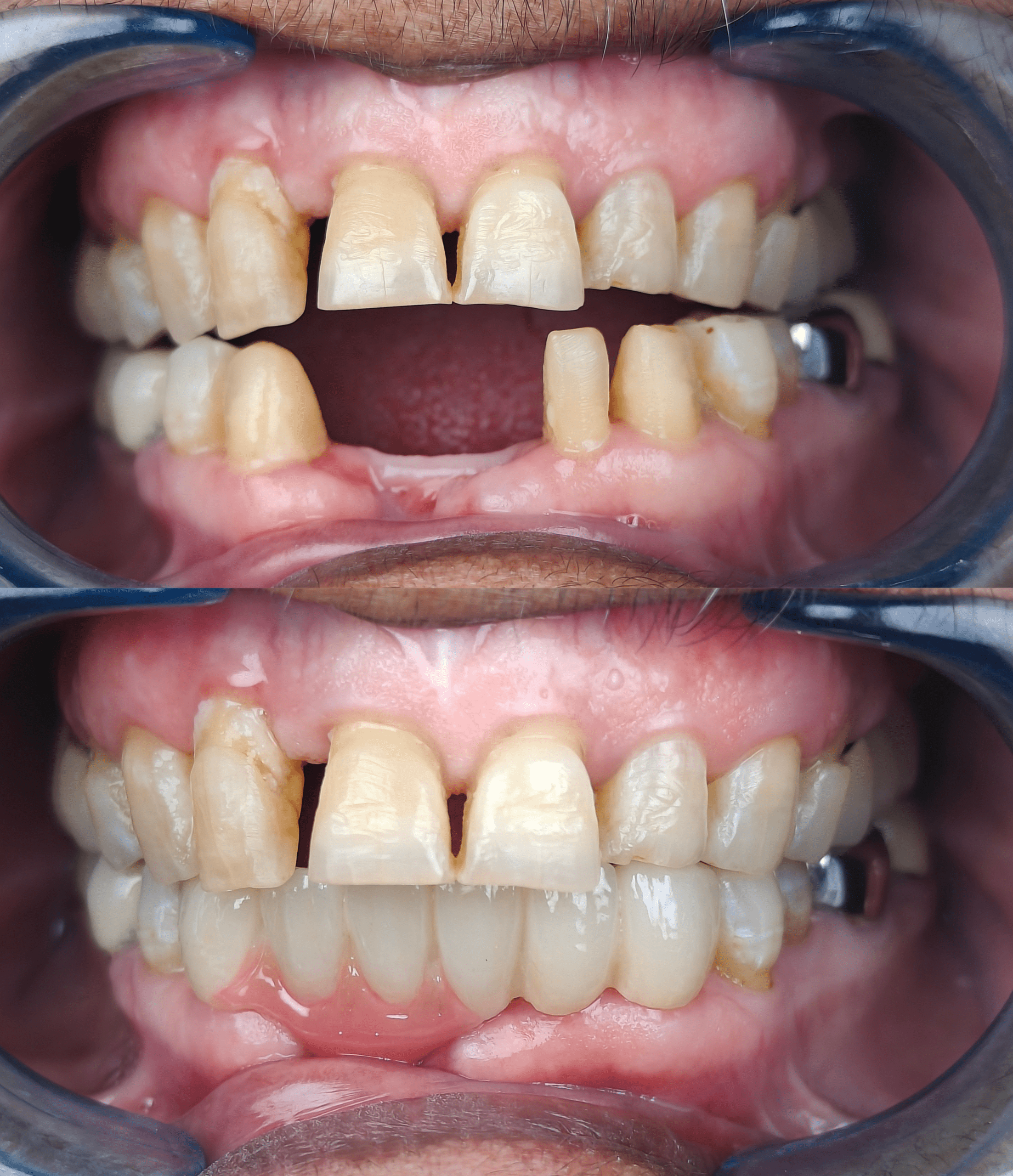 Missing teeth replaced with dental implants — before and after