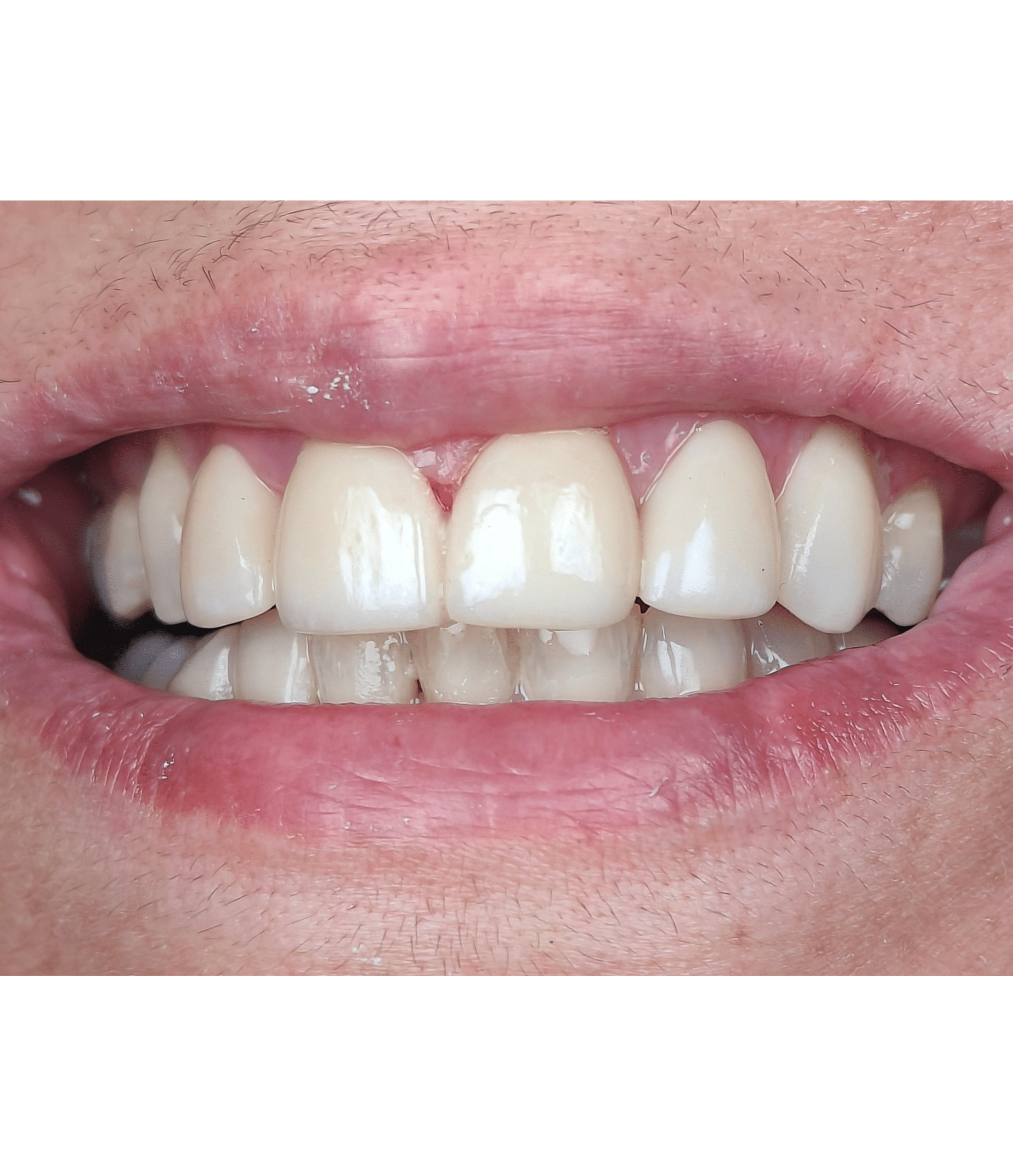 Confident smile after dental implant treatment at Summirow Dental Surat